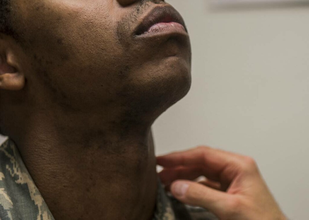 FRITAK: Dersom du sliter med «pseudofolliculitis barbae» kan ansatte i det amerikanske luftforsvaret søke om fem års barberingsfritak. FRITAK: Dersom du sliter med «pseudofolliculitis barbae» kan ansatte i det amerikanske luftforsvaret søke om fem års barberingsfritak.