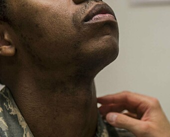 Skjeggregler fører til diskriminering, viser studie gjennomført av militære hudleger